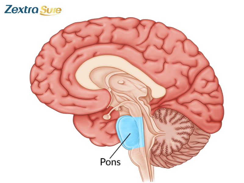 pontine-stroke (6) - Copy
